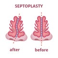 Septoplasty. Nose surgery.